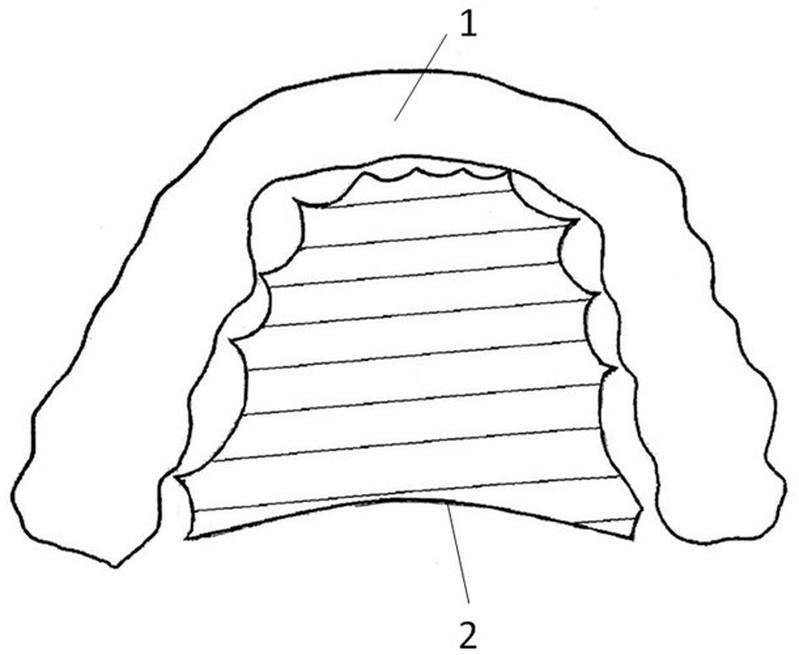 一种加强型牙套-爱企查