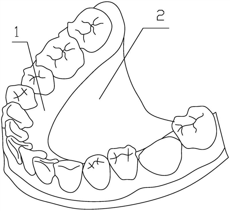 摘要附图摘要一种便于3d打印建模的牙模脱模模型,包