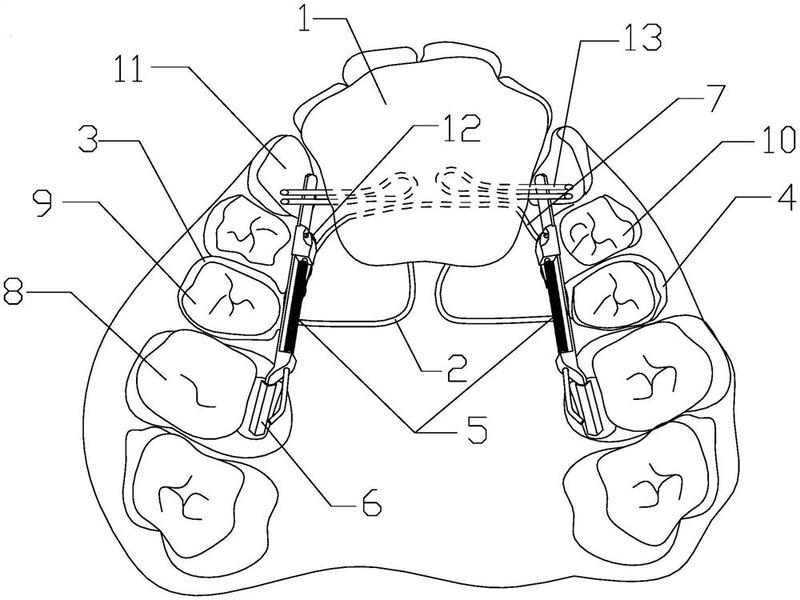 所述矫治器包括安装在上颌牙舌侧的平导支抗装置和对称安装在上颌舌侧