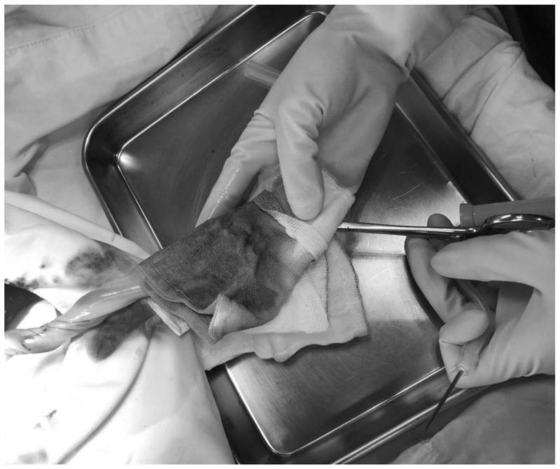 一种有效降低脐带血采集污染率的脐带深度消毒方法及其应用