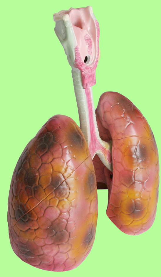 吸烟肺癌早期模型