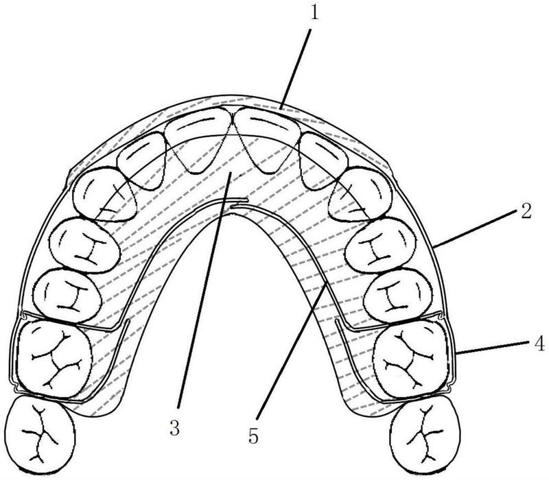 一种改进的hawley活动保持器-爱企查