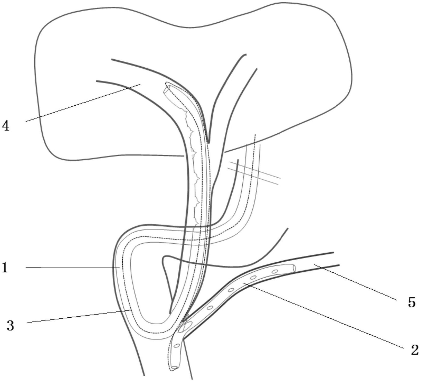 一种直接拔除型胆汁胰液引流管-爱企查
