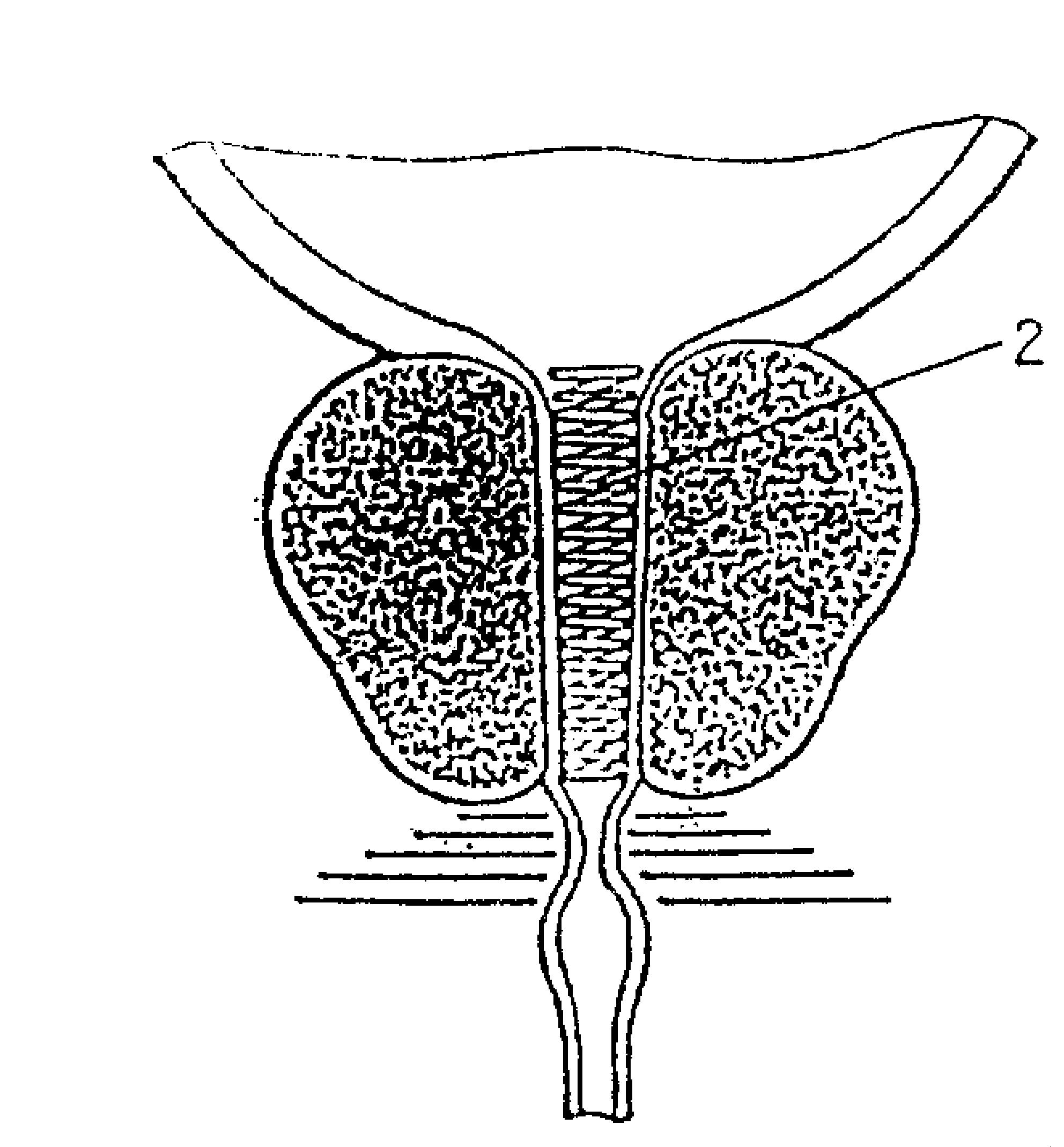 治疗前列腺增生症用记忆合金支架-爱企查